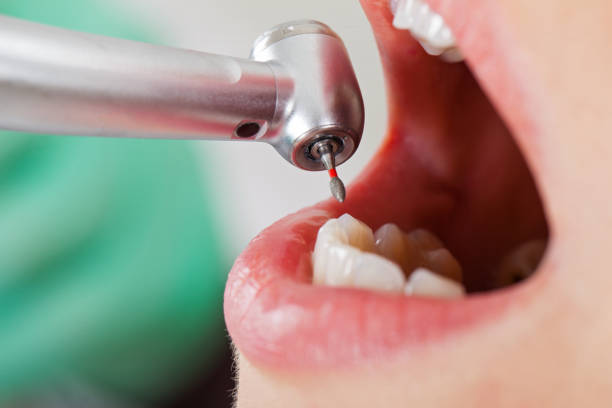 Best Emergency Wisdom Teeth Removal in Sconsin Dells, WI